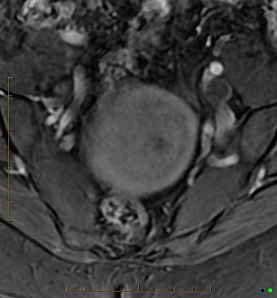 File:Adenomyosis uterus with hematometra (Radiopaedia 45779-50011 Axial T1 C+ fat sat 7).jpg