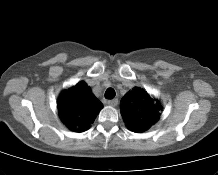 File:Adenosquamous lung carcinoma (Radiopaedia 22035-22030 non-contrast 16).jpg