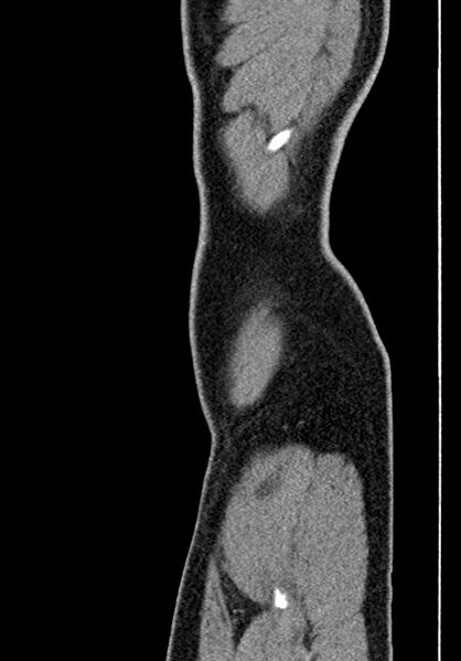 File:Adhesional small bowel obstruction (Radiopaedia 58900-66131 Sagittal C+ portal venous phase 9).jpg