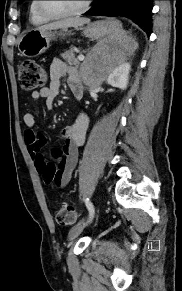 File:Adrenal lymphoma (Radiopaedia 73730-84529 Sagittal C+ portal venous phase 73).jpg