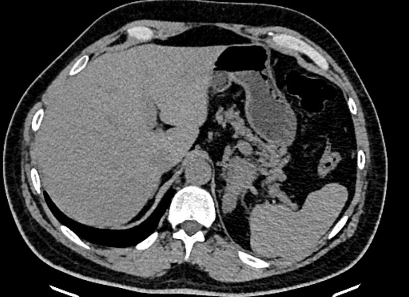 File:Adrenal metastases (Radiopaedia 73082-83791 Axial non-contrast 38).jpg