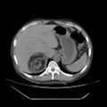 Adrenal myelolipoma (Radiopaedia 41843-44834 Axial non-contrast 10).jpg