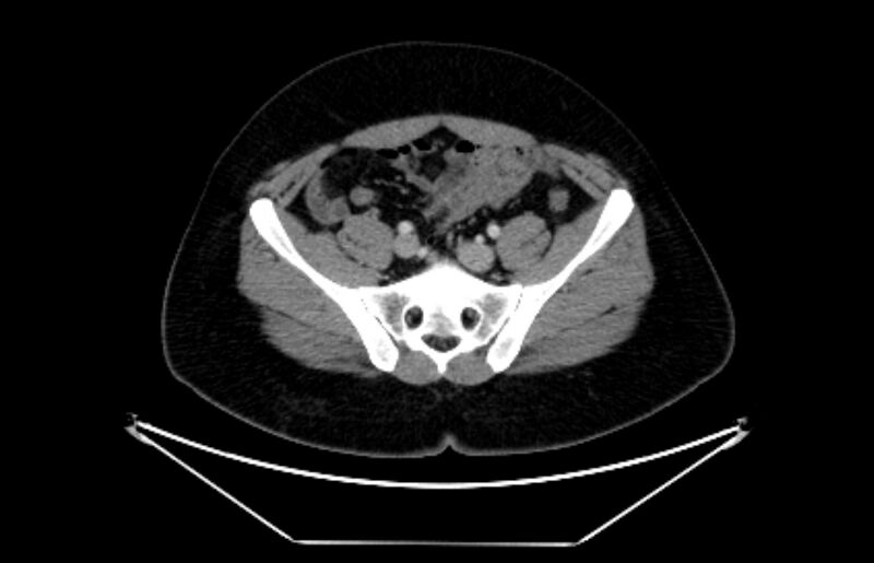 File:Adrenocortical carcinoma (Radiopaedia 80134-93438 Axial C+ portal venous phase 99).jpg