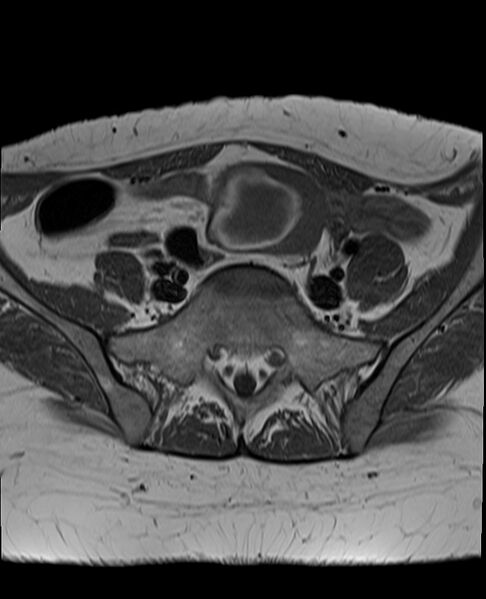 File:Adult granulosa cell tumor of the ovary (Radiopaedia 71581-81950 Axial T1 7).jpg