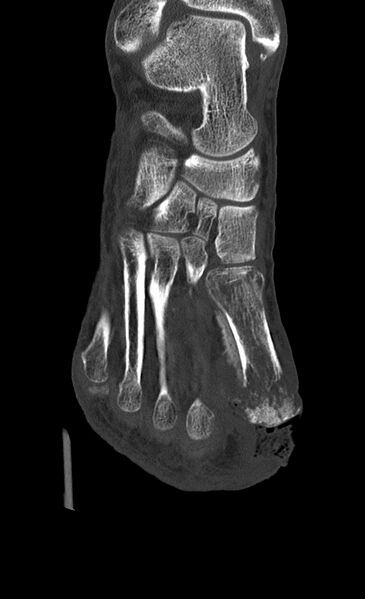 File:Advanced osteomyelitis due to open metatarsal fracture (Radiopaedia 83891-99095 Coronal bone window 10).jpg