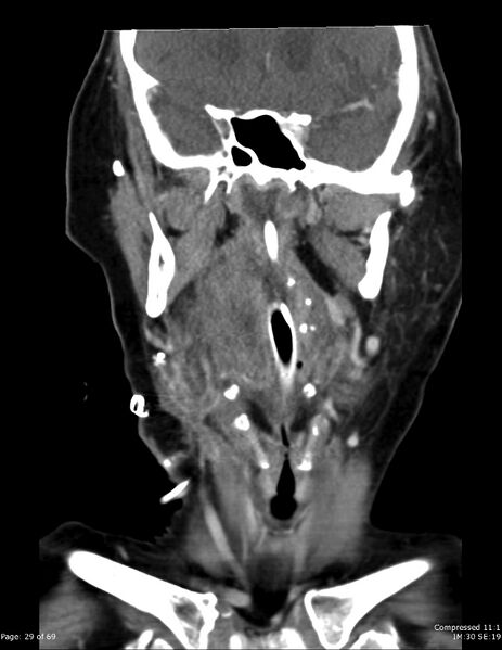 File:Airway narrowing post surgical drainage of neck abscess (Radiopaedia 28885-29206 B 20).jpg