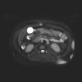 Ampullary tumor (Radiopaedia 27294-27479 T2 SPAIR 4).jpg