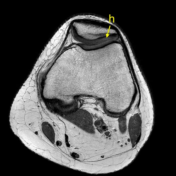 File:Anatomy Quiz (MRI knee) (Radiopaedia 43478-46866 A 9).jpeg