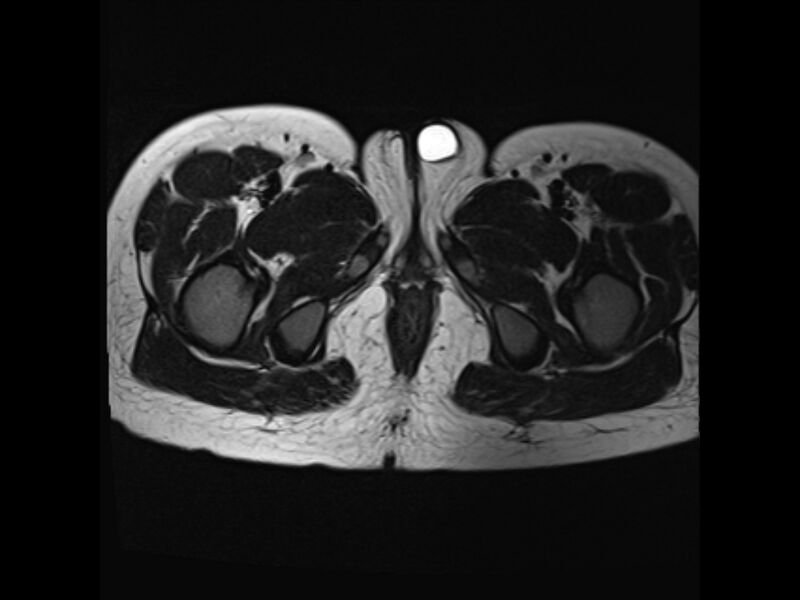 File:Androgen insensitivity syndrome (Radiopaedia 42046-45081 Axial T2 25).jpg