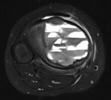 MRI scan: showing fluid levels