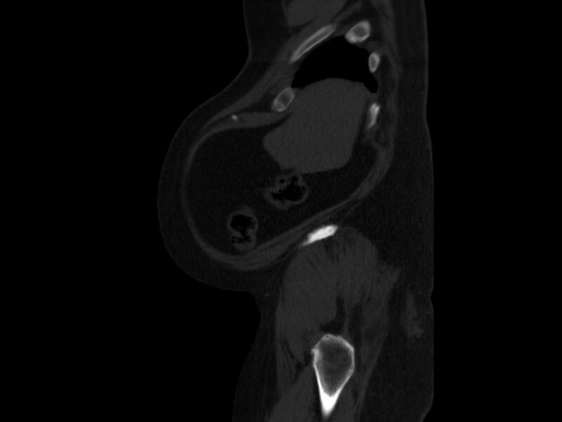 File:Ankylosing spondylitis (Radiopaedia 44609-48357 Sagittal bone window 105).jpg