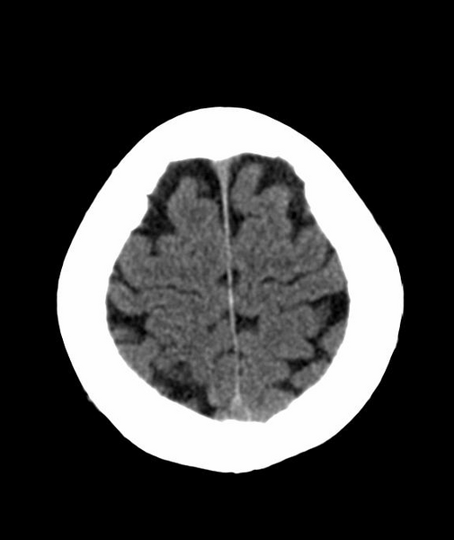 File:Anomalous intracranial venous drainage (Radiopaedia 28161-28418 Axial 50).png