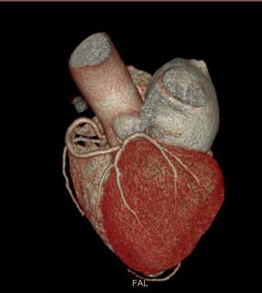 File:Anomalous left coronary artery- prepulmonic course (Radiopaedia 29253-29667 3D VRT 7).JPG