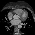 Anomalous origin of left circumflex artery from right coronary sinus (Radiopaedia 72563-83117 B 61).jpg
