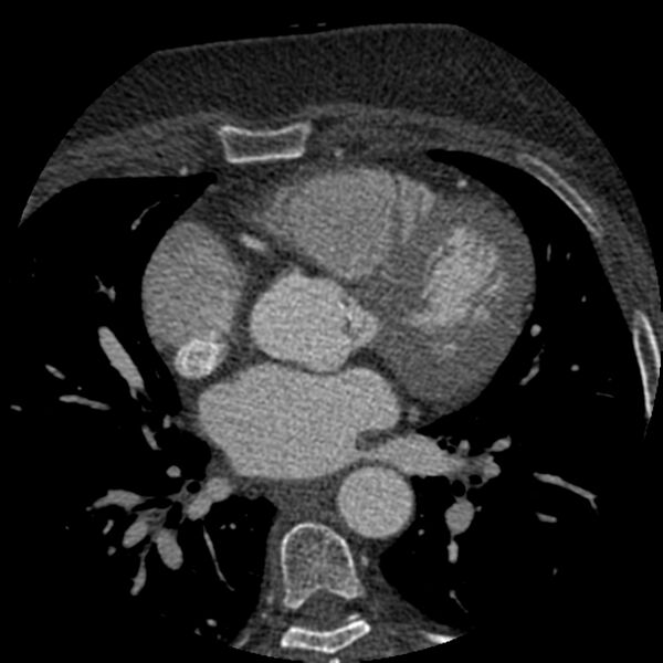 File:Anomalous origin of left circumflex artery from right coronary sinus (Radiopaedia 72563-83117 B 61).jpg