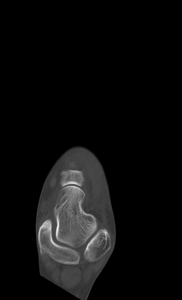File:Anterior calcaneal process fracture (Radiopaedia 47384-51989 Axial bone window 11).png