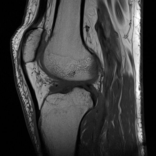 File:Anterior cruciate ligament tear - ramp lesion (Radiopaedia 71883-82322 Sagittal T1 11).jpg