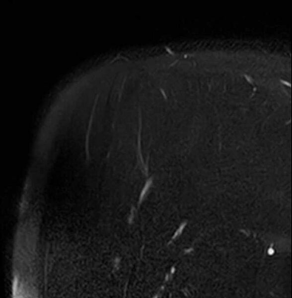 File:Anterior labral tear- extensive (Radiopaedia 73682-84476 Coronal T2 fat sat 26).jpg