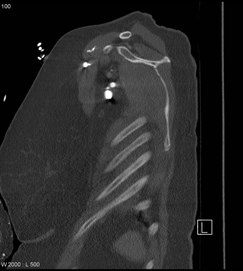 Anterior shoulder dislocation (CT) (Radiopaedia 59032-66309 Sagittal bone window 50).jpg