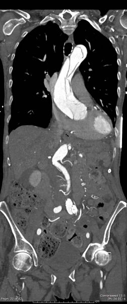 File:Aortic dissection with extension into aortic arch branches (Radiopaedia 64402-73204 A 33).jpg