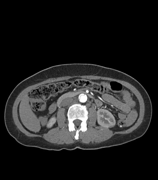 File:Aortic dissection with renal ischemia (Radiopaedia 76573-88338 A 76).jpg