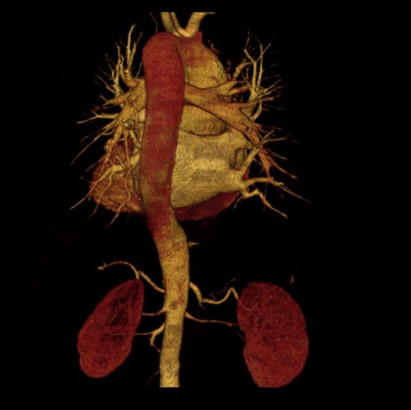 File:Aortic dissection with rupture into pericardium (Radiopaedia 12384-12647 D 20).jpg