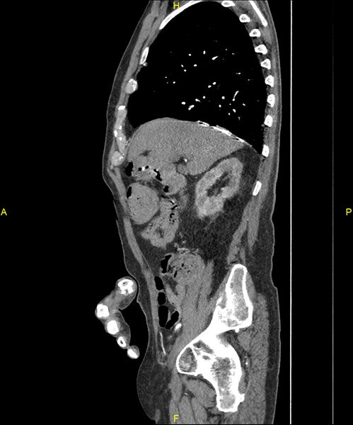 File:Aortoenteric fistula (Radiopaedia 84308-99603 C 107).jpg