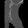 Apical pneumothorax on cervical spine CT (Radiopaedia 45343-49368 Sagittal bone window 4).jpg