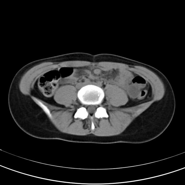 File:Appendicitis and incidental bicornuate uterus (Radiopaedia 22833-22853 Axial non-contrast 28).jpg