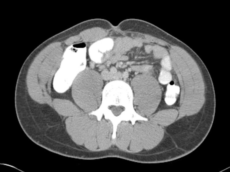 File:Appendicitis and incidental foregut duplication cyst (Radiopaedia 52962-58916 A 46).jpg