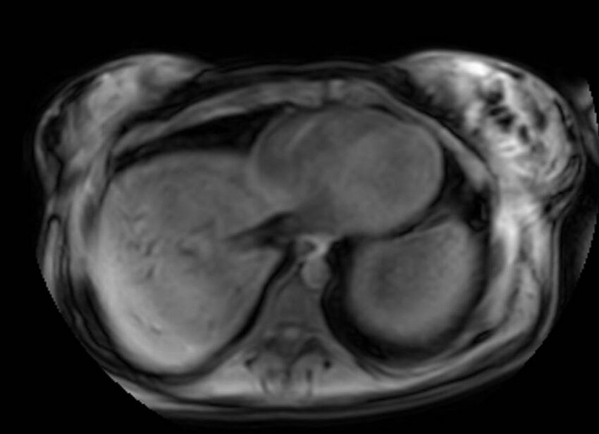 Appendicitis in gravida (MRI) (Radiopaedia 89433-106395 Axial DIXON 2).jpg