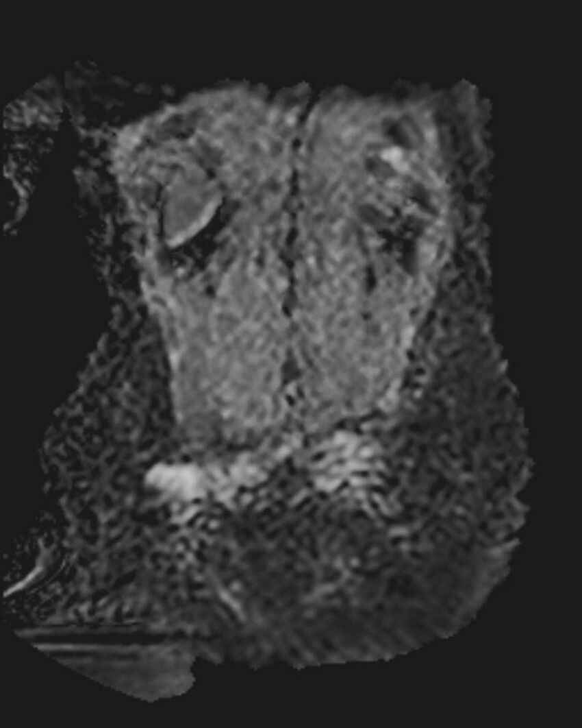 Appendicitis in gravida (MRI) (Radiopaedia 89433-106395 Coronal ADC 50).jpg