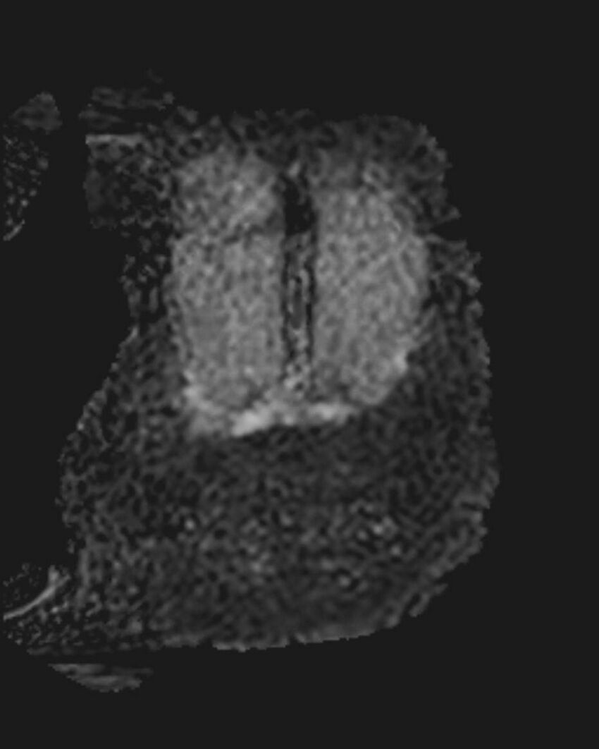 Appendicitis in gravida (MRI) (Radiopaedia 89433-106395 Coronal ADC 53).jpg