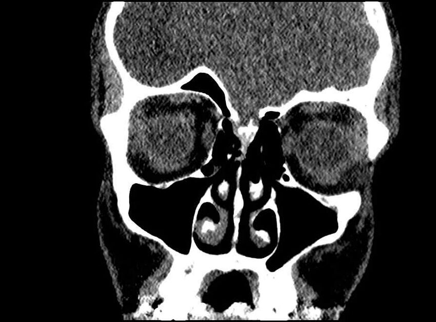 Arachnoid cyst- extremely large (Radiopaedia 68741-78450 Coronal bone window 55).jpg