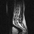 Arachnoid cyst - spinal (Radiopaedia 66835-76157 Sagittal T2 7).jpg