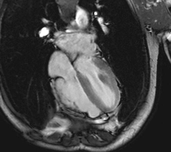 File:Arrhythmogenic right ventricular cardiomyopathy (Radiopaedia 39806-42237 D 44).jpg