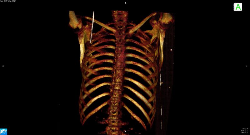 File:Arrow injury to the neck (Radiopaedia 75225-86323 3D bone 1).jpg