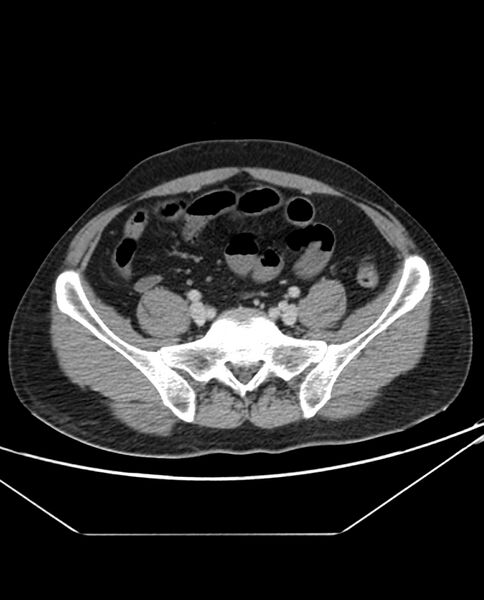 File:Arterial occlusive mesenteric ischemia (Radiopaedia 84641-100054 A 89).jpg