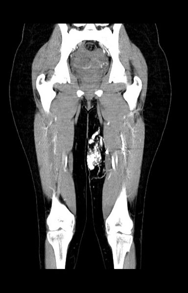 File:Arteriovenous malformation of the thigh (Radiopaedia 14948-14883 C+ arterial phase 13).jpg