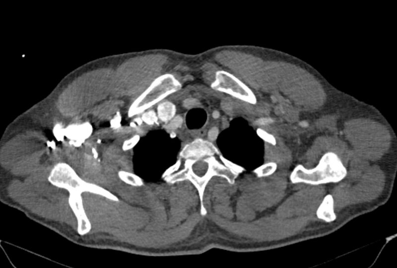 File:Ascending aortic aneurysm (Radiopaedia 86279-102297 C 4).jpg