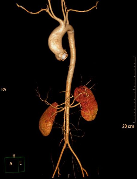File:Ascending aortic pseudoaneurysm (Radiopaedia 28638-28910 D 32).jpg