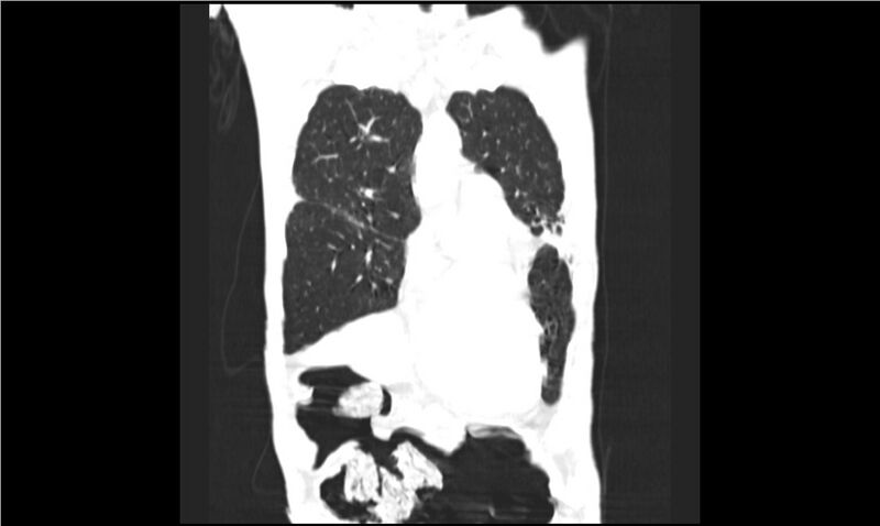 File:Aspergilloma (Radiopaedia 20788-20701 Coronal lung window 4).jpg