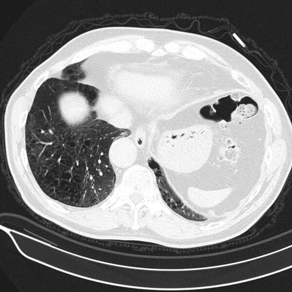 File:Aspergilloma (Radiopaedia 24521-24804 Axial lung window 23).jpg