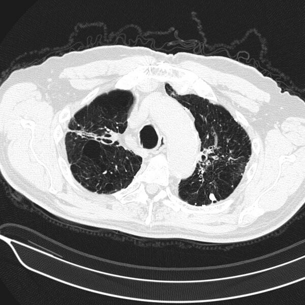 File:Aspergilloma (Radiopaedia 24521-24804 Axial lung window 4).jpg