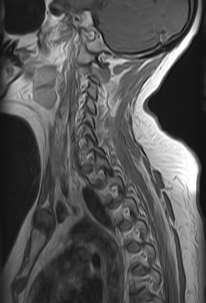 File:Astrocytoma - spinal cord (Radiopaedia 69769-79758 Sagittal T1 C+ 10).jpg