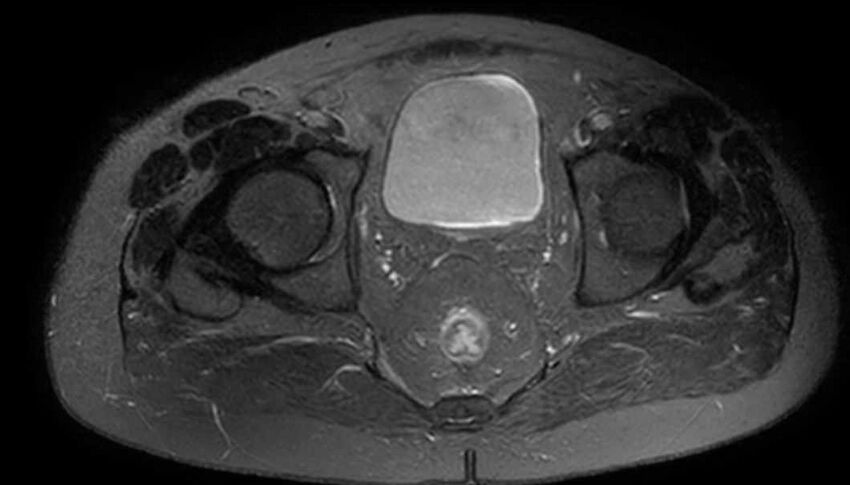 Atypical lipomatous tumor - thigh (Radiopaedia 68975-78734 Axial T2 fat sat 95).jpg