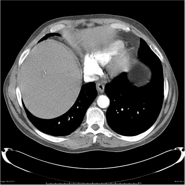 File:Atypical pneumonia - Q fever (Radiopaedia 21993-21989 C+ arterial phase 40).jpg