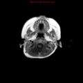 Atypical teratoid rhabdoid tumor (Radiopaedia 10712-11183 Axial T1 C+ 17).jpg