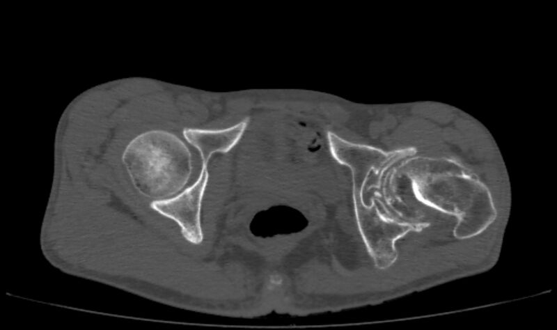 File:Avascular necrosis of the left hip (Radiopaedia 75068-86125 Axial bone window 60).jpg