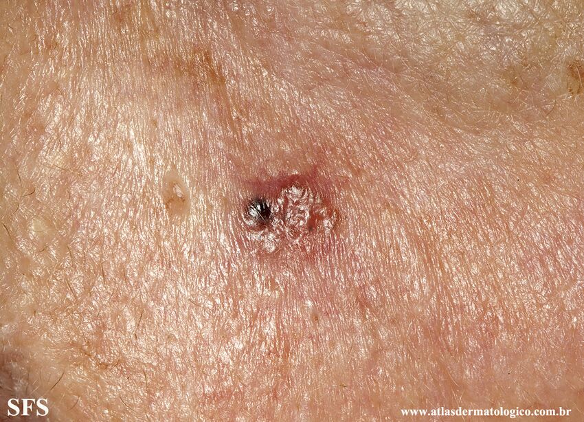 Basal Cell Carcinoma (Dermatology Atlas 303).jpg